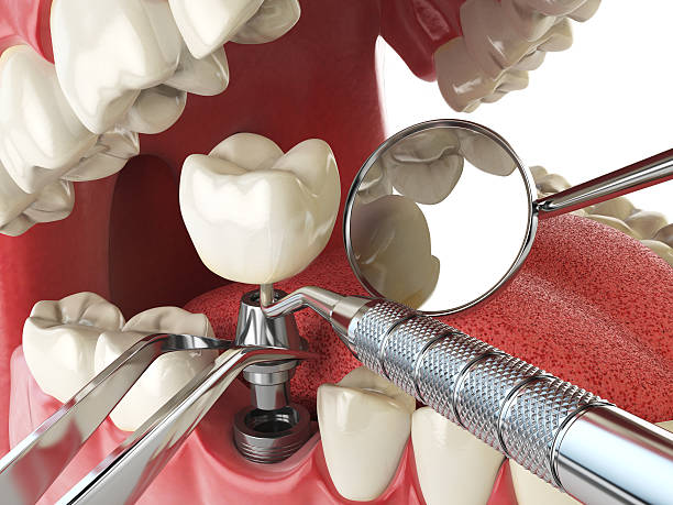 Best Knocked-Out Tooth Emergency  in Hagerman, ID